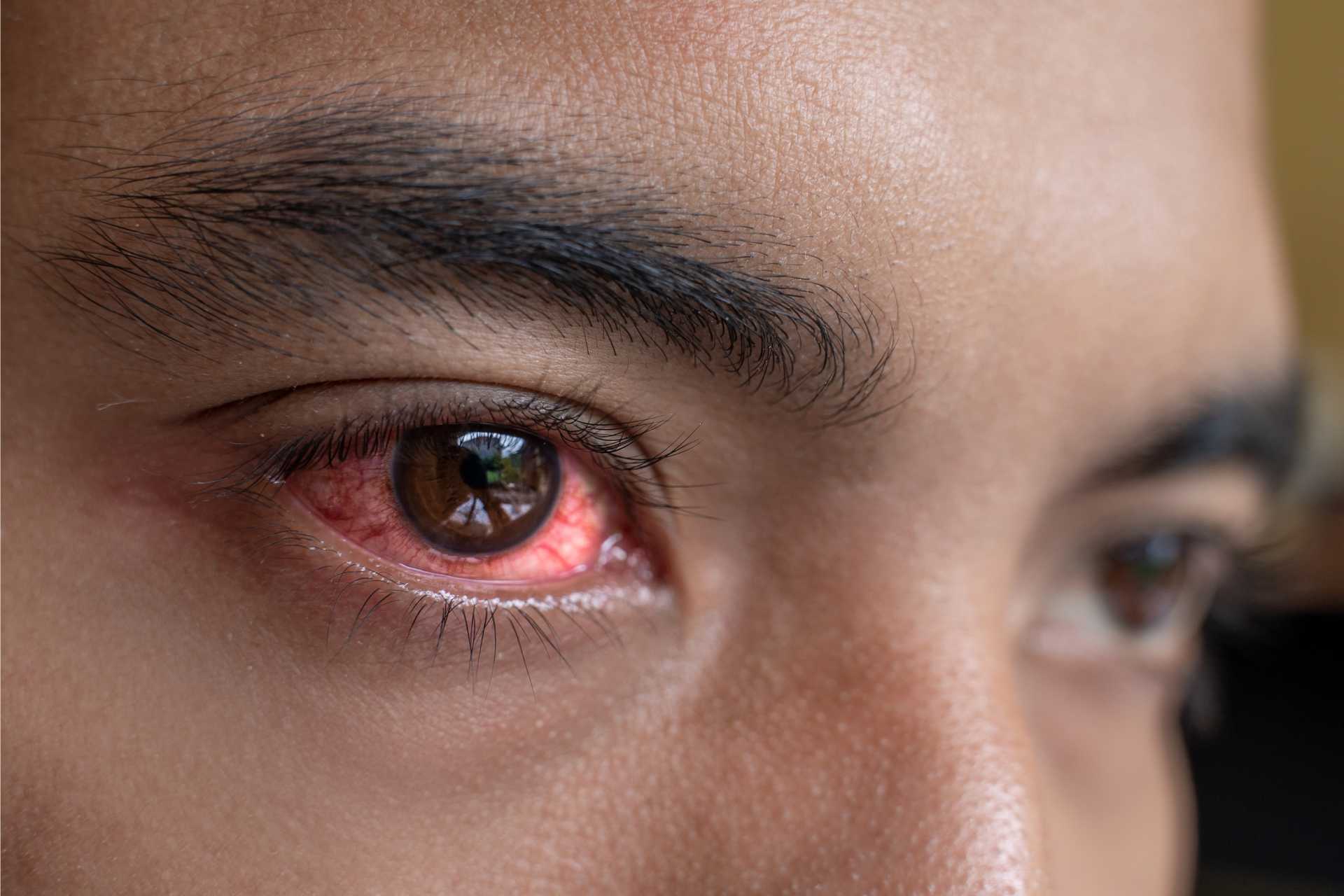 A man with pink eye and eye infections