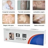 pornhint Pornhint 20g Chinese Medical White Spot Disease Cream Pigment...