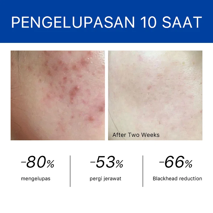 Refresh+ Acne Removal Light Cream