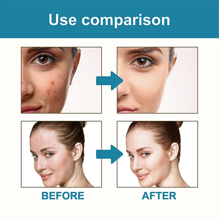 Star heart pimple patch
