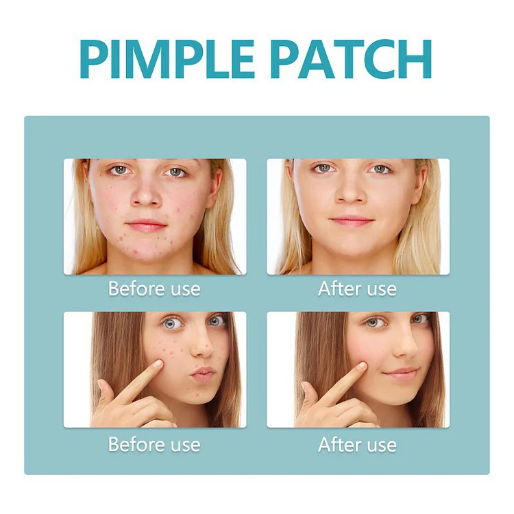 Breathable waterproof repair hydrocolloid acne patch