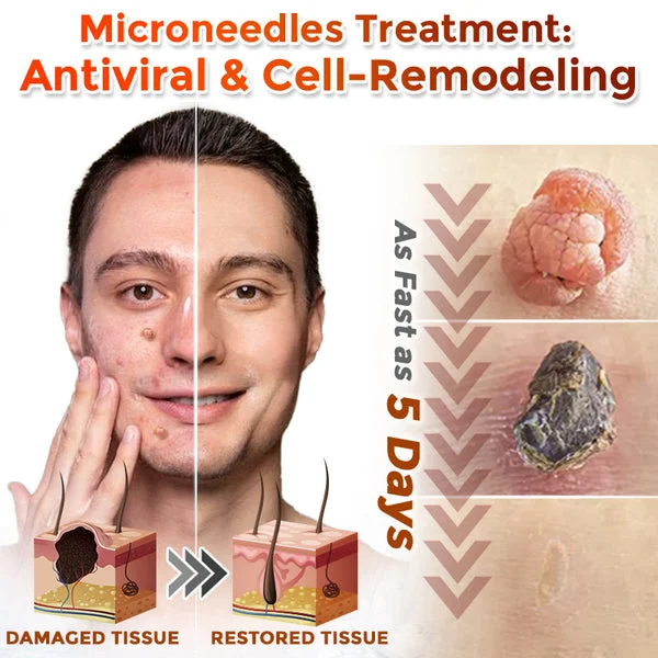 Yunpso™ MicroNeedle Botanic Skin Tag Removal Patch