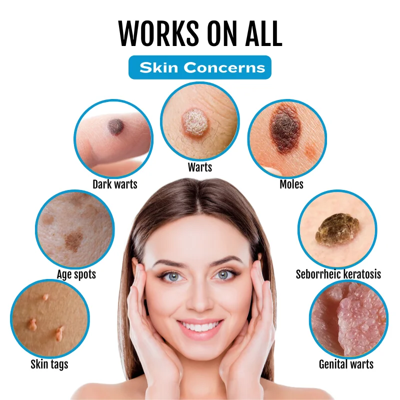 Bikenda&reg; SpotlessDerm Mole and Wart Laser Pen