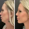 Ultimate Face Revitalizing Device