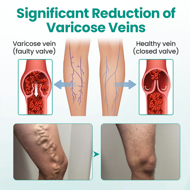 LegRenew Varicose Veins Patch