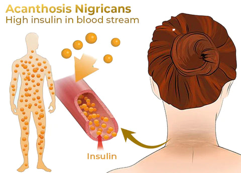 FurzeroTM Acanthosis Nigricans Peeling Oil