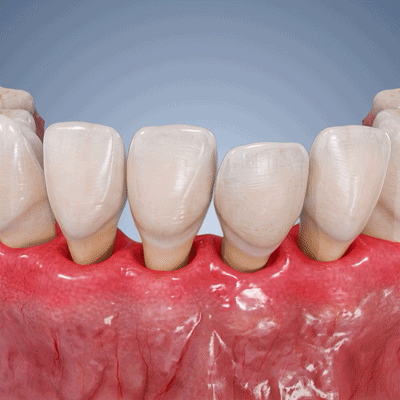 Pureluxo® Periodontal Repair Gel