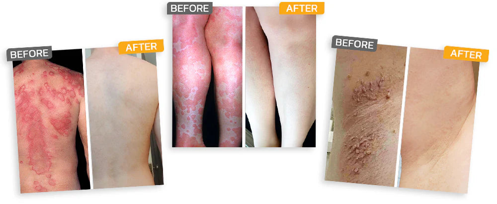 Official Store:LOVILDS® Magnesium Herbal Spray Fast Relief for Psoriasis & Eczema | No-Rub, SteroidFree