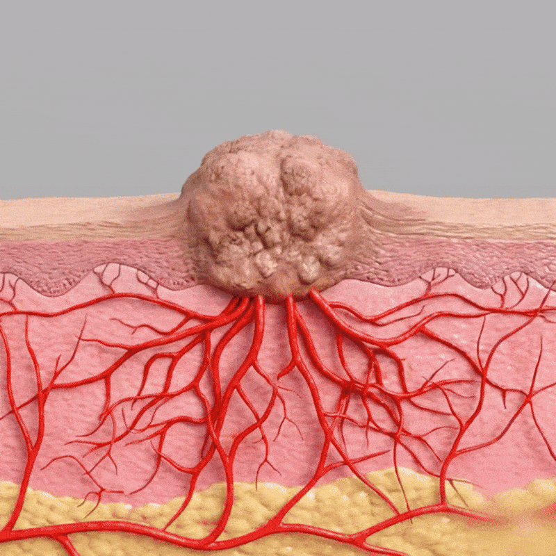 ROSOPL® WartLift Wart Removal Fluid 25 Timilk® WartLift Corn Removal Liquid (A)