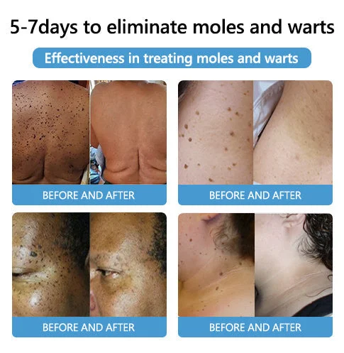 🐝🐝Bee Venom Mole and Wart Treatment Cream