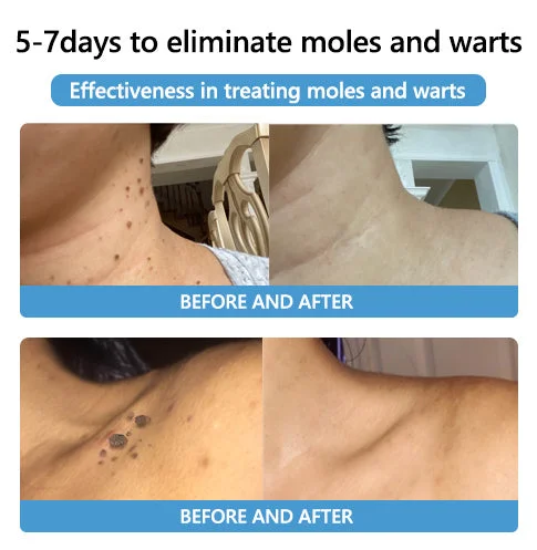 🐝🐝Bee Venom Mole and Wart Treatment Cream