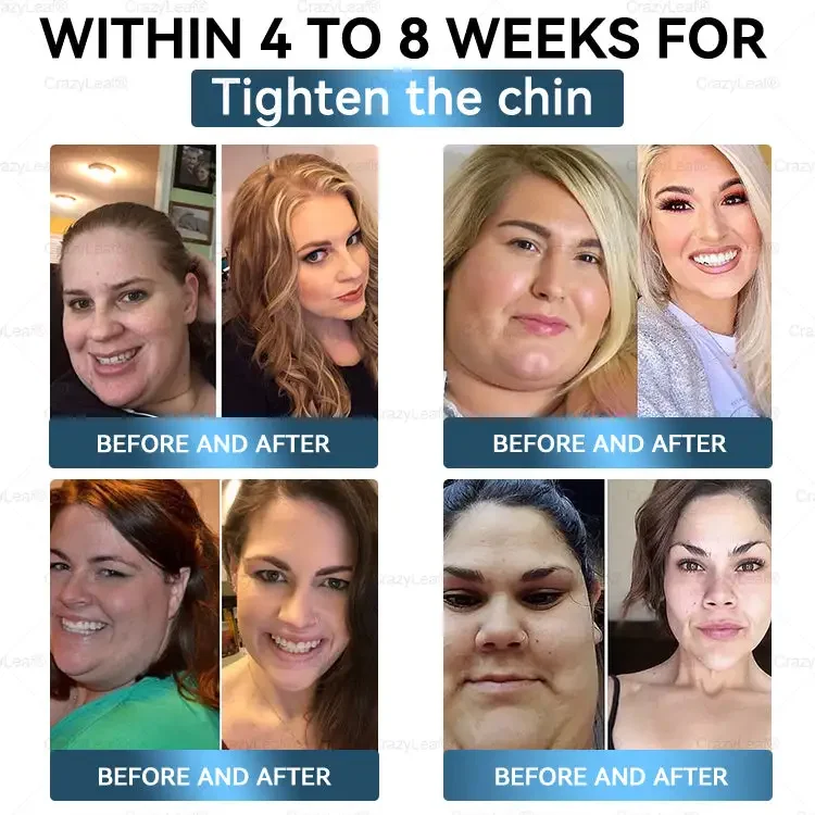 	CrazyLeaf&reg; Sculpting Microneedle Patch