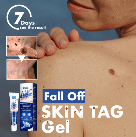 Fall Off Skin Tag Gel