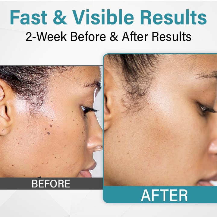 	BQYOOM&trade; MoleLaser Painless Laser Mole Removal Pen
