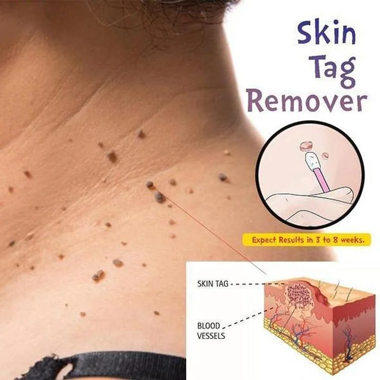 skin tag remover 1