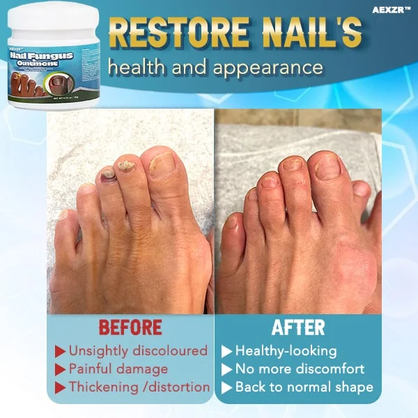 Nanpusa™ Quick-healing Nail Fungus Ointment