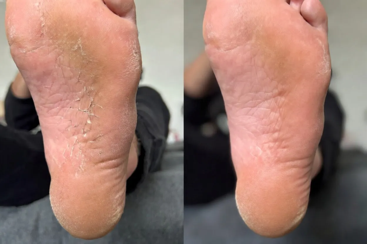 🎁 NEWYUO™ Limited-Time Offer 🎁 - Don't miss out!Tea Tree Oil Foot Cream (Repairs Dry Cracked Heels, Soothes Tired Feet, Eliminates Odor & Restores Soft Skin)