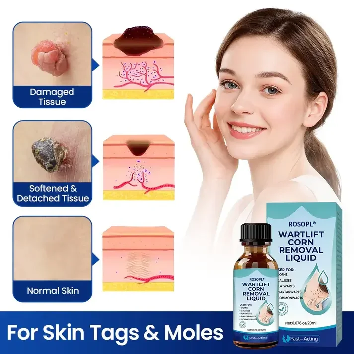 ROSOPL® WartLift Wart Removal Fluid 27