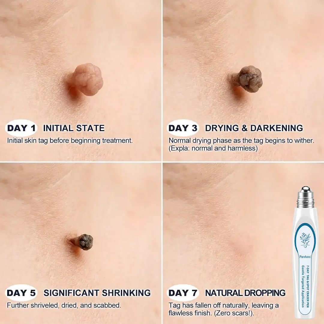 	Pureluxo&reg; 𝟕-𝐃𝒂𝘆 𝐒𝗸𝐢𝐧 𝐓𝒂𝗴 & 𝐒𝐩𝙤𝐭 𝐄𝐫𝒂𝐬𝙚𝐫 Painless & Scar-Free Advanced Imperfection Remova𝗜 Ro𝗜𝗜erba𝗜𝗜 Pen