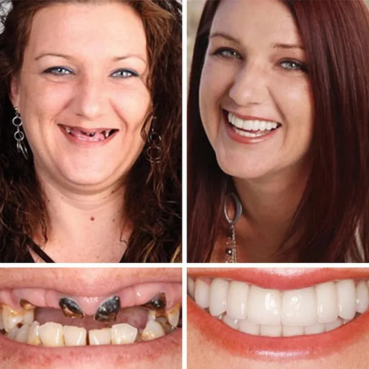 Ends Today: 70% OFF! ⏰ Medical Full Denture with Strong Suctiond🦷Obtain American Dental Association (ADA) Certification