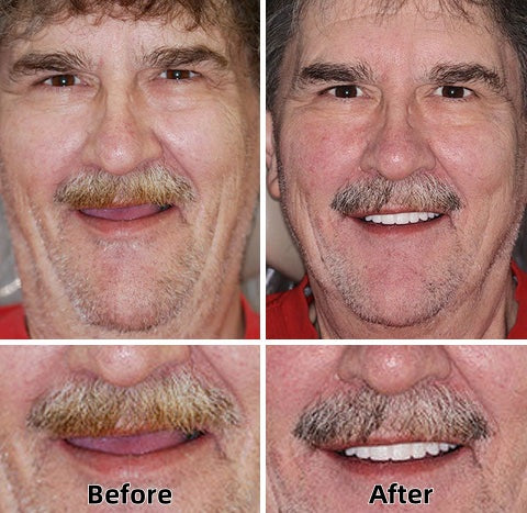 Natravor™-Advanced Custom-Fit Functional Dentures