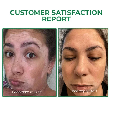 Linglang™ Vitiligo Correction Revitalizing Elixir
