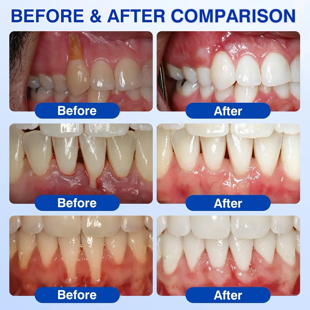 𝐆𝐮𝐦𝐑𝐞𝐯𝐢𝐯𝐞 Periodontal Repair Gel