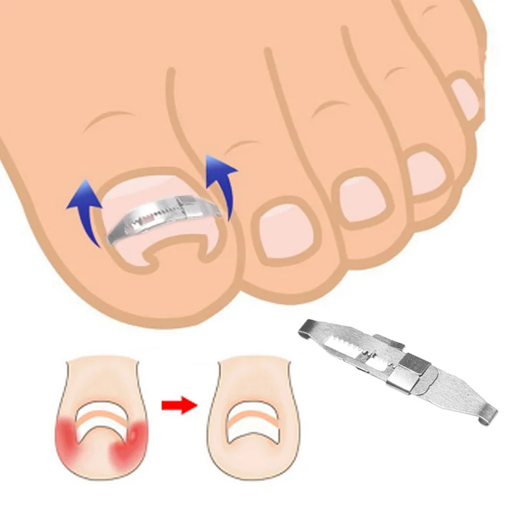 Ingrown Toe Nail Correction Tool