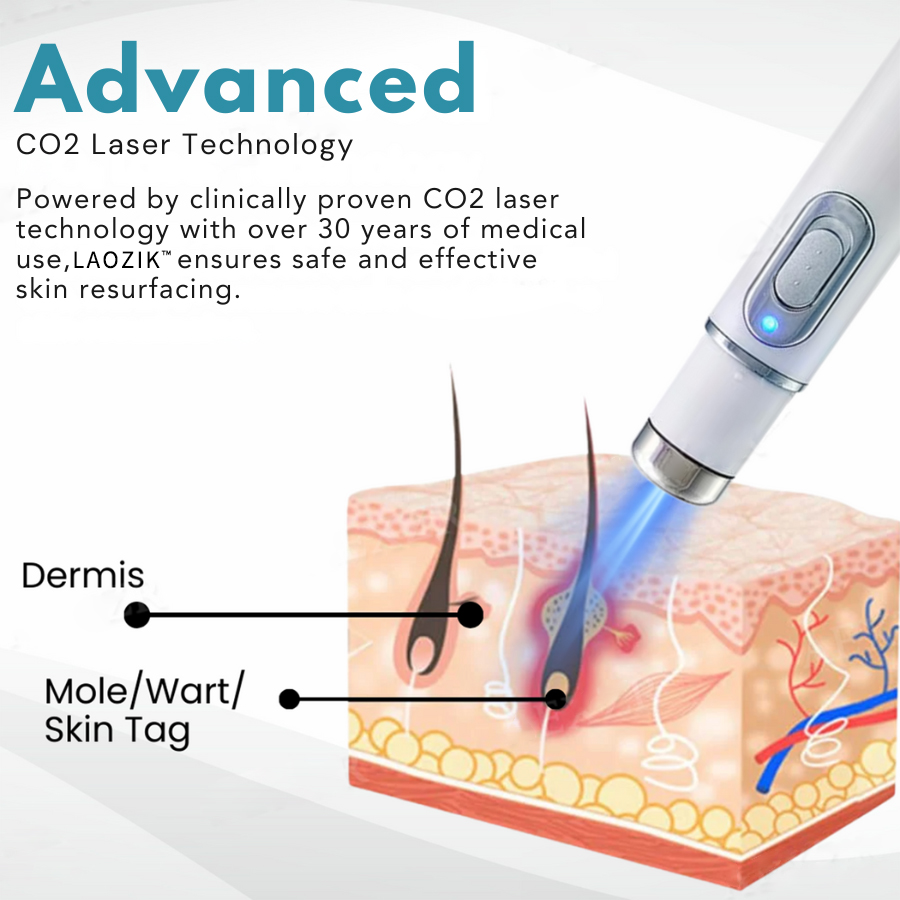 LAOZIK® Non-Invasive Mole en Wratten Removal Laser Pen
