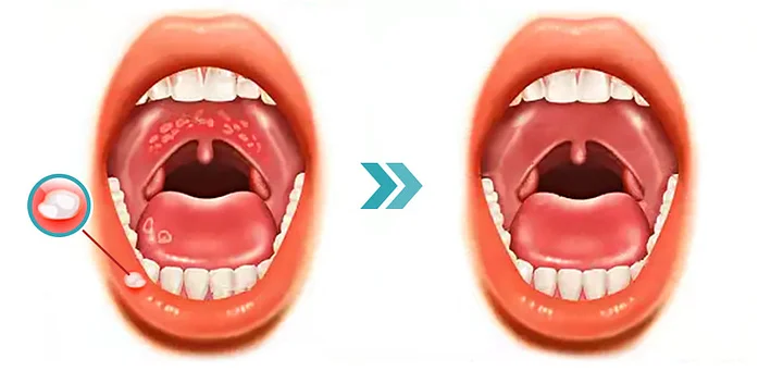 SmileMate™ Removal of tartar and plaque bacteria and various oral problems