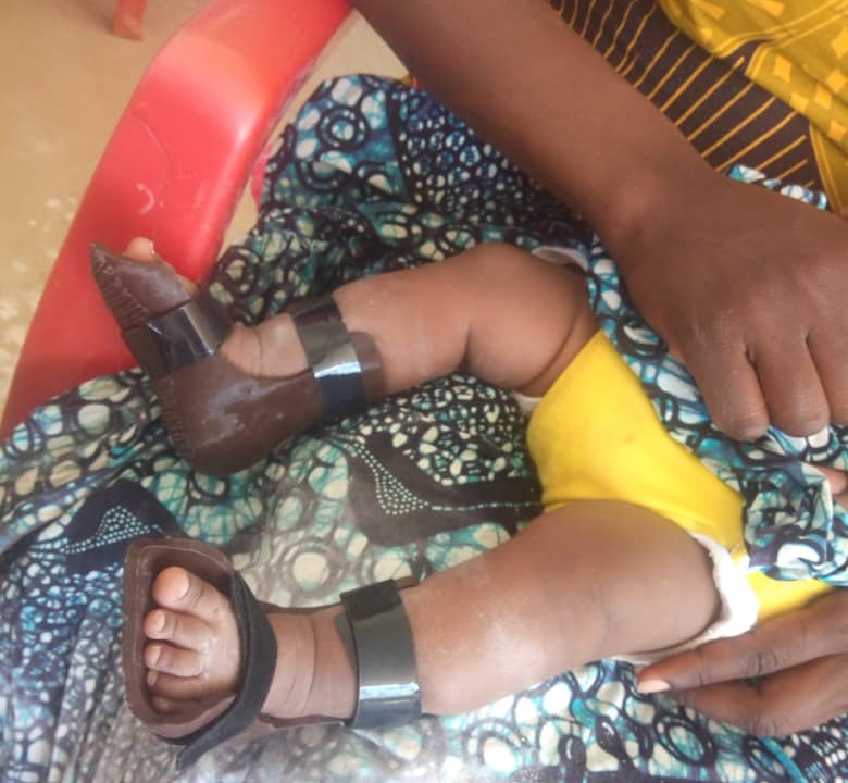The 3d printed orthotic device with traditionally made brace for clubfoot babies.
