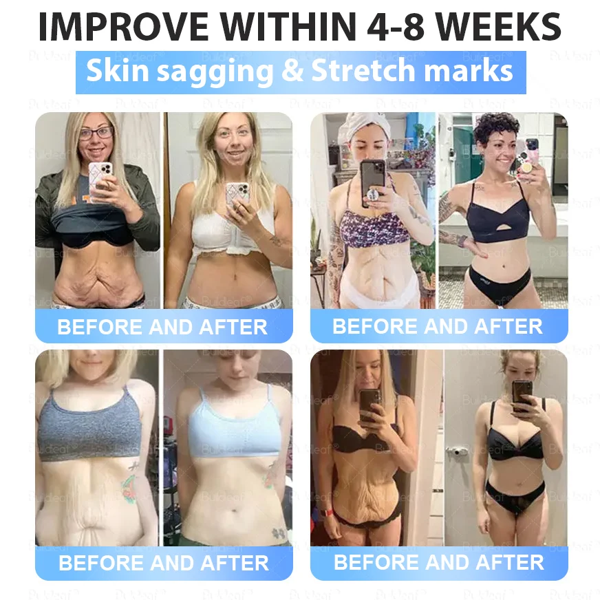 🏥FDA Store | 𝐵uil𝗱𝐿ea𝐟&reg; 𝑺𝑀𝗚T-𝑮𝐋𝑃-1 𝐒limming & 𝐻ealth 𝑁ano 𝑀icroneedle 𝑃atch with Collagen & Matrixyl 3000 丨Obesity,Cardiovascular Diseas, Diabetes, Sleep Apnea, Joint Problems and More