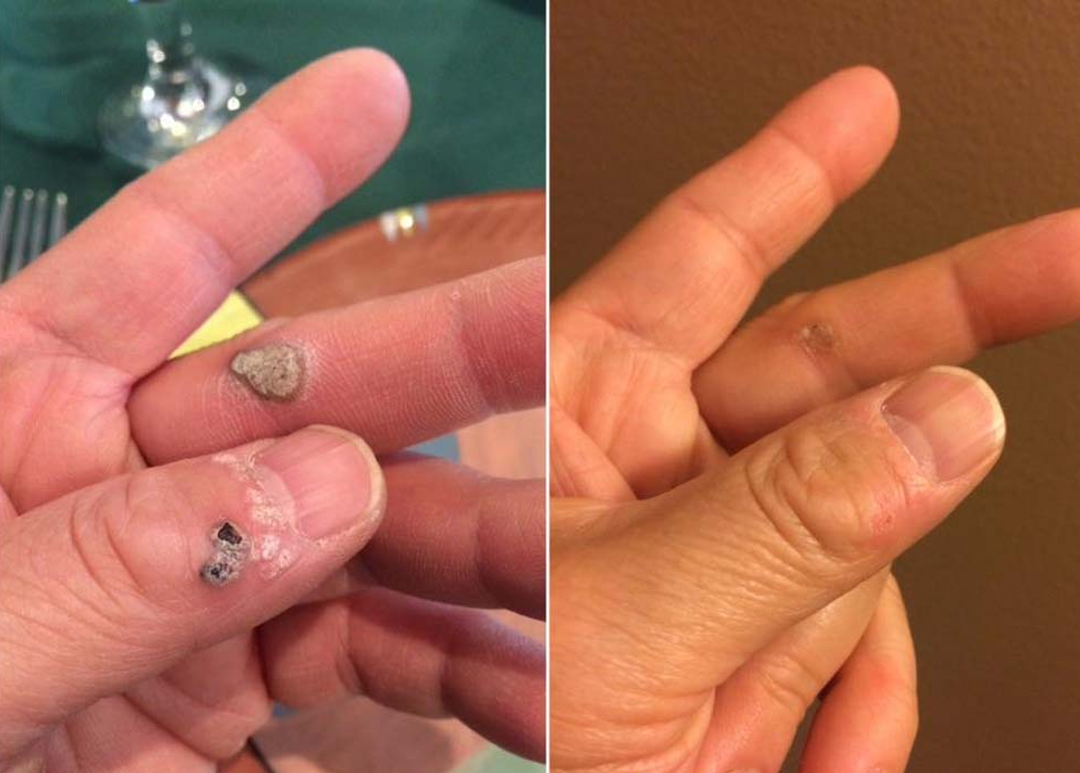 ROSOPL® WartLift Wart Removal Fluid 23 Timilk® WartLift Corn Removal Liquid (A)