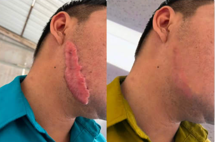 NESLEMY™ Advanced Scar Gel