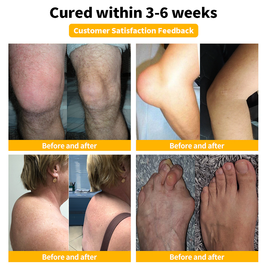 💎💎𝐀𝐞𝐞𝐡𝐟𝐞𝐧𝐠™ 𝐁𝐞𝐞 𝐕𝐞𝐧𝐨𝐦 𝐀𝐝𝐯𝐚𝐧𝐜𝐞𝐝 𝐉𝐨𝐢𝐧𝐭 𝐚𝐧𝐝 𝐁𝐨𝐧𝐞 𝐓𝐡𝐞𝐫𝐚𝐩𝐲 𝐂𝐫𝐞𝐚𝐦 (𝐍𝐞𝐰 𝐙𝐞𝐚𝐥𝐚𝐧𝐝 𝐁𝐞𝐞 𝐄𝐱𝐭𝐫𝐚𝐜𝐭 - 𝐒𝐩𝐞𝐜𝐢𝐚𝐥𝐢𝐳𝐞𝐬 𝐢𝐧 𝐎𝐫𝐭𝐡𝐨𝐩𝐞𝐝𝐢𝐜 𝐃𝐢𝐬𝐞𝐚𝐬𝐞𝐬 𝐚𝐧𝐝 𝐀𝐫𝐭𝐡𝐫𝐢𝐭𝐢𝐬 𝐏𝐚𝐢