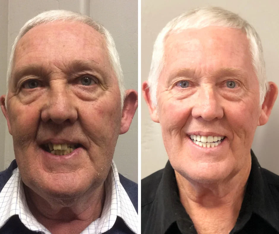 Clinclii™ --Advanced Customized Full Denture Set🦷