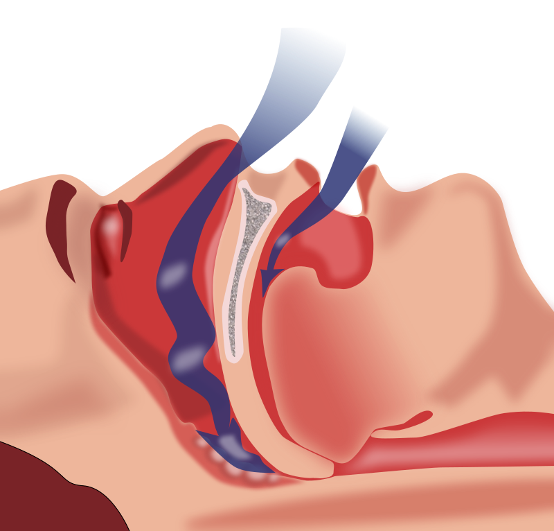 800px-Obstruction_ventilation_ap.png__PID:d37cc194-a84b-4b4e-ae49-050851f60bbe