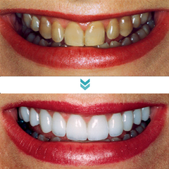 SmileMate™ Removal of tartar and plaque bacteria and various oral problems