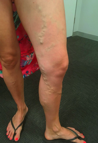 Oveallgo™ Varicose Veins Spray