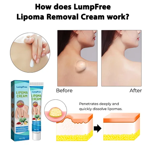 South Moon LumpFree Lipoma Removal Cream