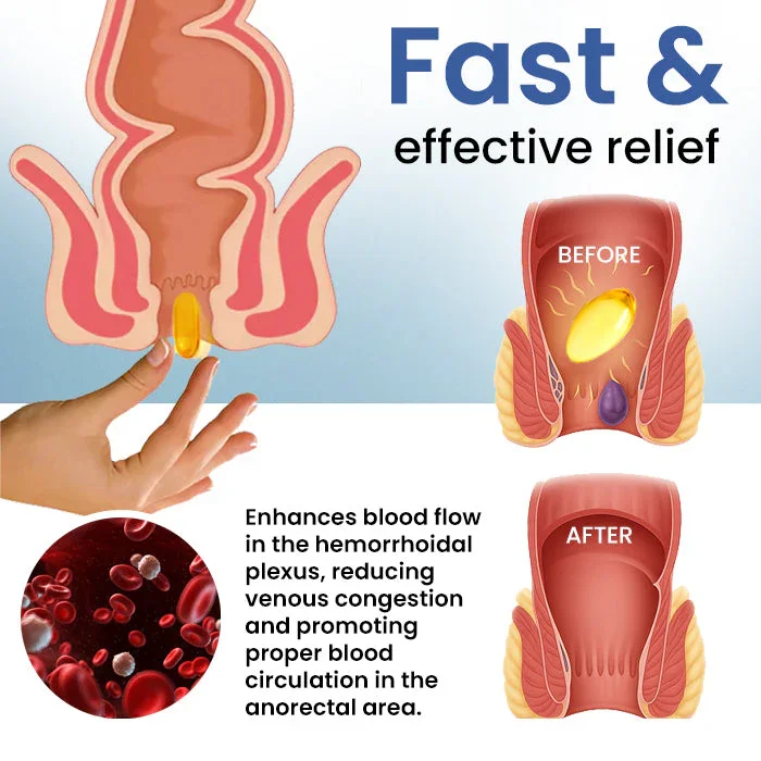 Natural Hemorrhoid Capsules