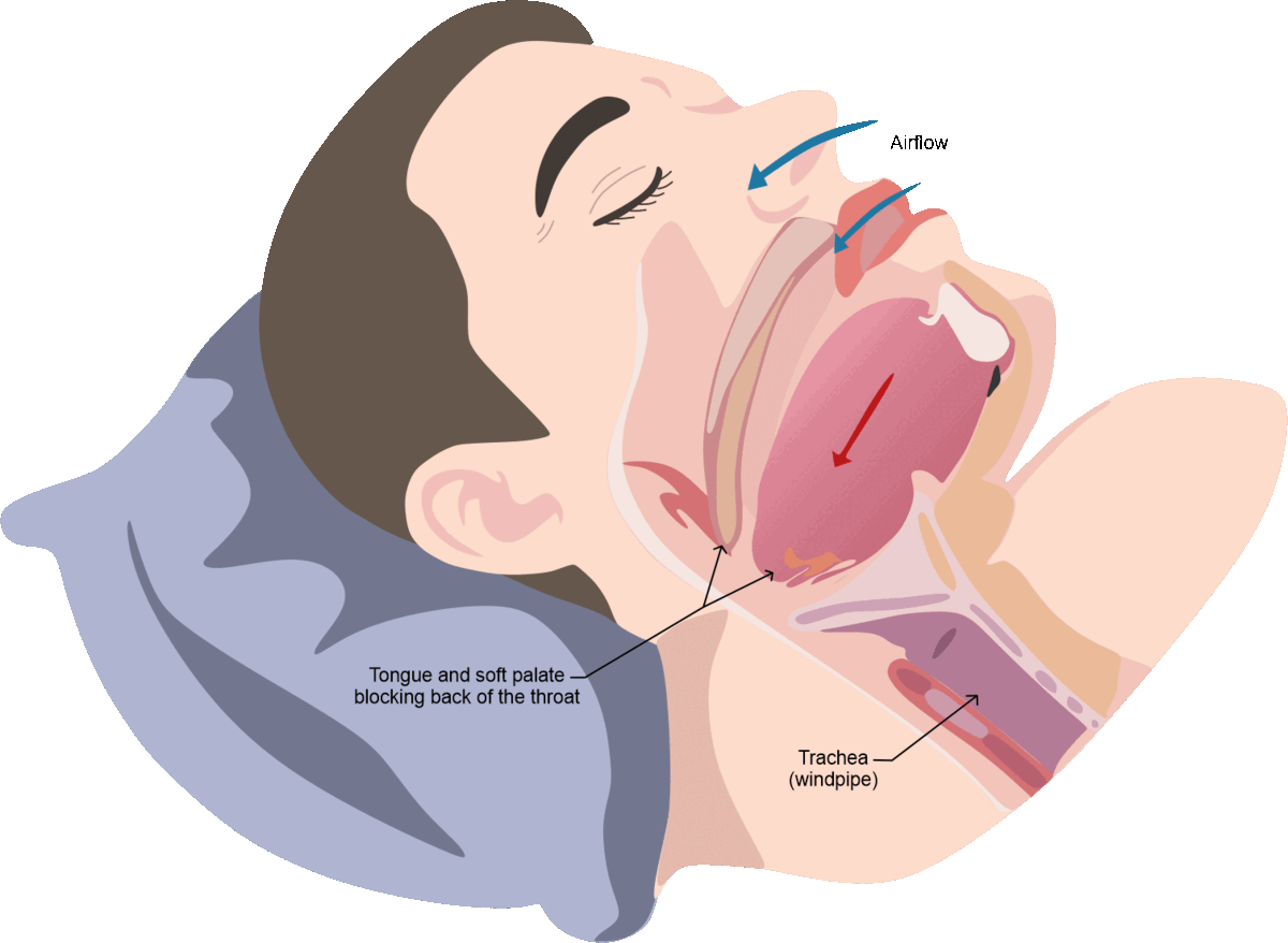 Obstructive-Sleep-Apnea.gif__PID:f26a8af8-5a9f-4ec2-9aef-b6071e828749