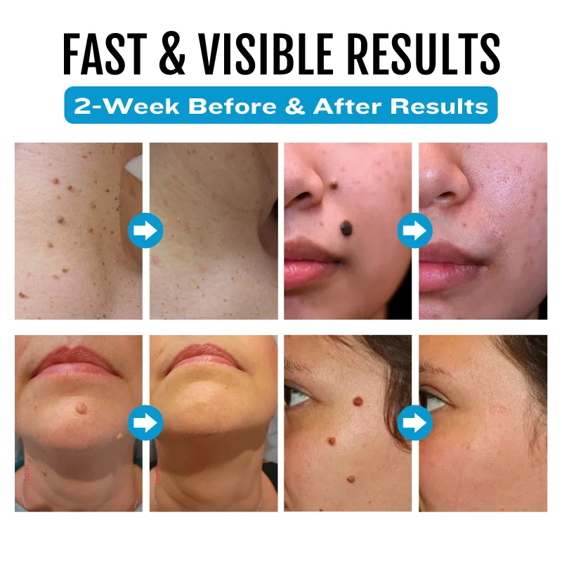 Bikenda&reg; SpotlessDerm Mole and Wart Laser Pen