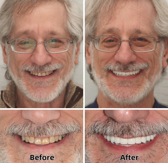 Natravor™-Advanced Custom-Fit Functional Dentures
