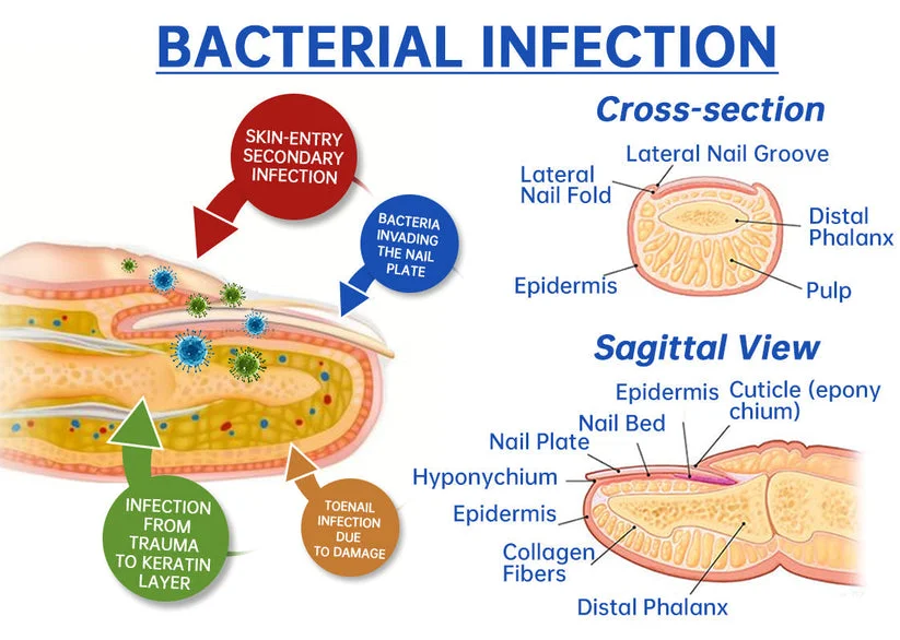 Pure Nails Fungus Laser Device