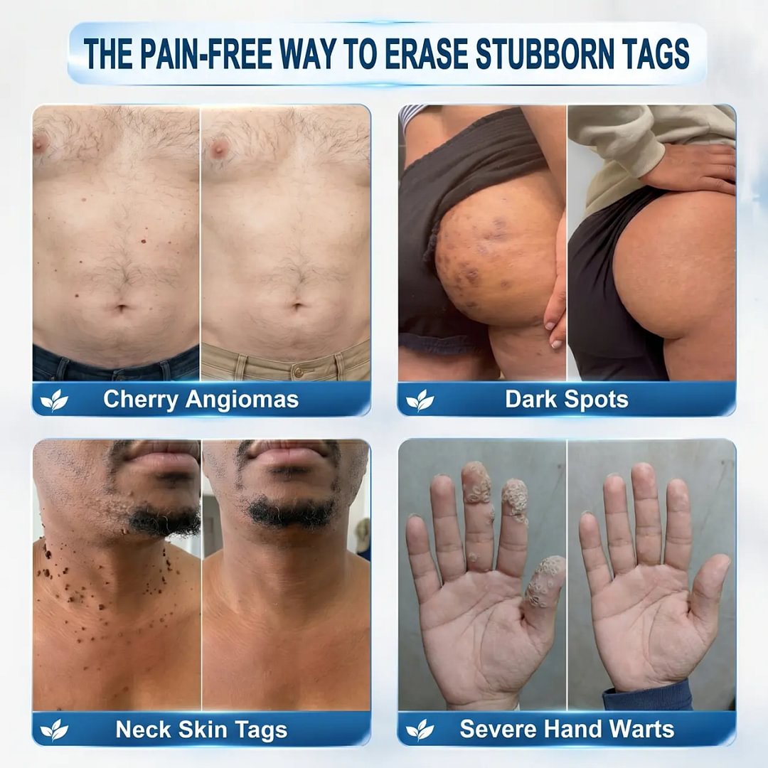 	Pureluxo&reg; 𝟕-𝐃𝒂𝘆 𝐒𝗸𝐢𝐧 𝐓𝒂𝗴 & 𝐒𝐩𝙤𝐭 𝐄𝐫𝒂𝐬𝙚𝐫 Painless & Scar-Free Advanced Imperfection Remova𝗜 Ro𝗜𝗜erba𝗜𝗜 Pen