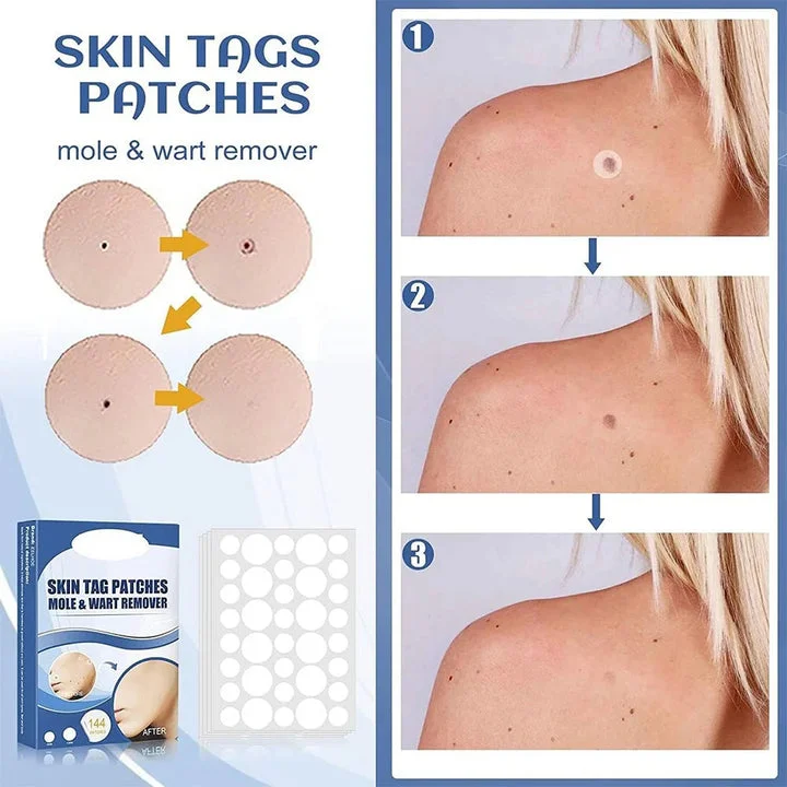 Gentle and Non-Invasive Care for Skin Tags