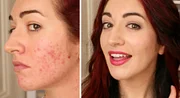 How to cover acne scars without aggravating skin