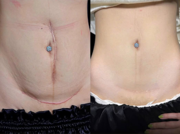 NESLEMY™ Advanced Scar Gel