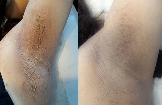 Dobshow® Wart and mole removal microneedle patch